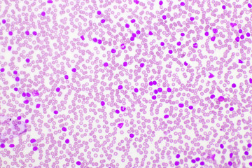 Picture of acute lymphocytic leukemia or ALL cells in blood smear, analyze by microscope, 400x