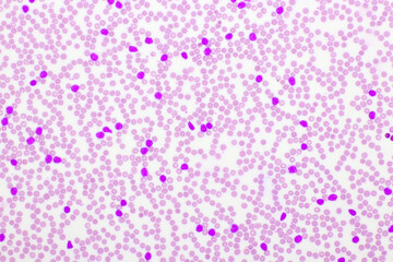 Picture of acute lymphocytic leukemia or ALL cells in blood smear, analyze by microscope, 400x