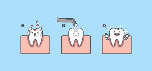 Dental cartoon Step of restoring cavity tooth by filling tooth illustration cartoon character vector design on blue background. Dental care concept.