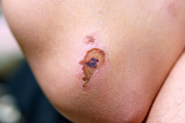 wound, a dried up crust change to scar on the skin on the elbow. selective focus