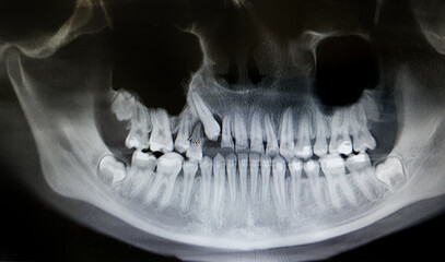 Dental x-ray with braces. Orthopantomography, OPG X-ray DR digital for teen teeth