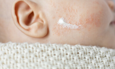 close-up view of dermatitis treatment applied ointment or cream on baby allergic skin cheek