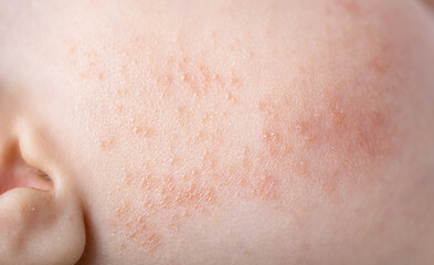 atopic dermatitis allergy rash skin problems on baby infant cheek on cheeks macro photo 
