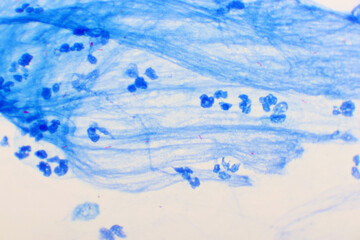 Mycobacterium tuberculosis positive (small red rod) in sputum smear, acid-fast stain, analyze by microscope 1000x