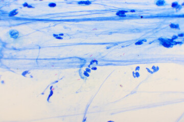 Mycobacterium tuberculosis positive (small red rod) in sputum smear, acid-fast stain, analyze by microscope 1000x