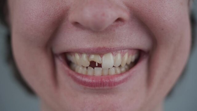 Topic restoration teeth after chips, trauma and damage. Close-up smiling woman with front tooth broken in half with resin pin. Restoration of teeth with fiberglass pins. Prosthetic dentistry concept