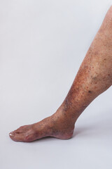 the leg of an elderly woman with varicose veins and its complications. Medical history. Thrombophlebitis