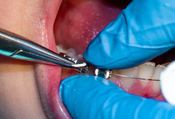 Installation of a metal arch on braces, orthodontics, treatment and alignment of teeth, shot...