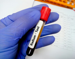 Obraz premium Blood sample for Radium (heavy metal) test, toxic metal. Diagnosis of radium toxicity