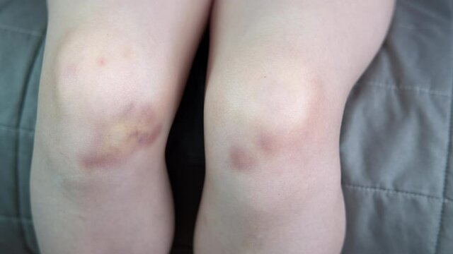 Bruise after fight. A view of a child with bruises on legs after children game.