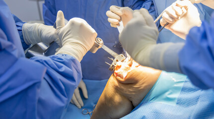 Orthopaedic surgeon in blue surgical gown using saw to cut the bone while total knee replacement surgery in osteoarthritis patient.Team of surgeons.Selective focus with blurred background.Motion blur.