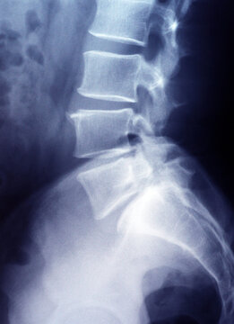 X-ray image of lumbar spine and pelvis