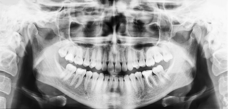 Panoramic dental x-ray of oral cavity with teeth