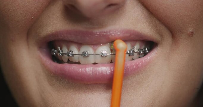 Teeth brushing. Close up woman with braces cleaning enamel by toothbrush. Dental hygiene, dentistry, orthodontic care
