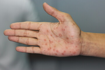 Secondary stage syphilis sores (lesions) on the palms of the hand. Referred to as 