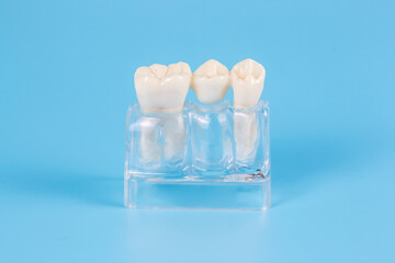 Dental crowns, imitation of a dental prosthesis of a dental bridge for one tooth