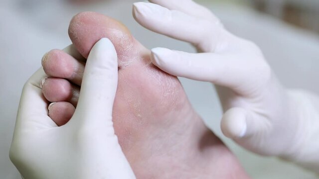 A dermatologist examines the foot of a diabetic patient. Problematic diabetic foot with cracks and scaling. Medical hardware pedicure in the salon. Diseases of the skin.