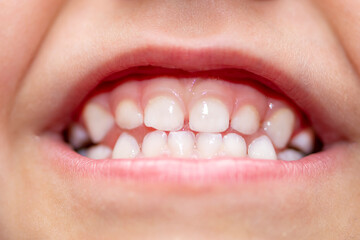 A wide-open child's mouth with beautiful white teeth, close-up. Concept: pediatric dentistry, brushing your teeth with toothpaste, healthy breathing.