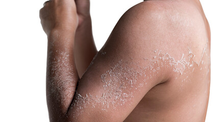 close up detail of a very dangerous sunburn peeling skin on the body of fat man from sunburn effect. Skin care in summer concept.