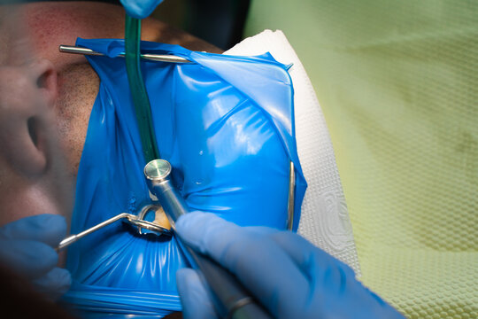 Dental treatment cofferdam in stomatology. Dentist using dental dam for tooth isolation.