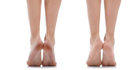 Legs of young woman before and after pedicure on white background