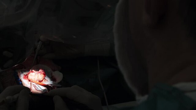 neurosurgery surgery, neurosurgeon removes the tumor from the head