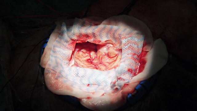 Brain close-up. Neurosurgery, brain surgery