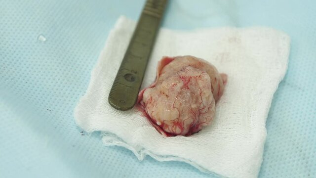 large tumor removed from the brain, close-up