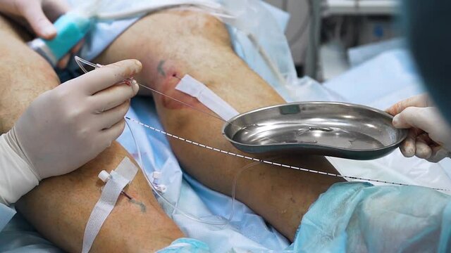 A phlebologist surgeon performs surgery on the legs of a patient with varicose veins with the help of a modern innovative manipulation method - laser ablation. The nurse wipes blood with gauze napkins
