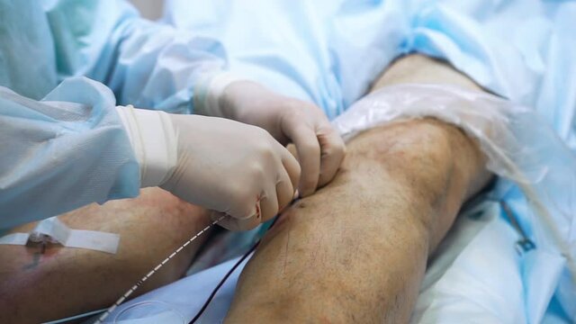 Doctor is performing medical procedure. Endovasal (endovenous) laser coagulation (obliteration) is used to eliminate varicose veins. Insertion of laser with luminous tip directly into vein.