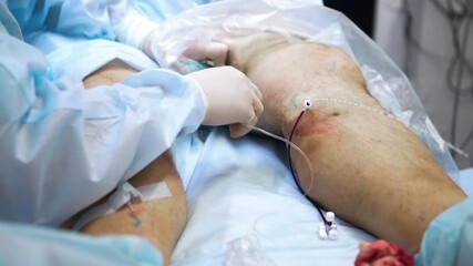 Endovasal laser coagulation- surgeon removes varicose veins with laser which glows under patient's skin. Nurse holds bandage around wound to prevent blood from flowing. Innovative method of treatment