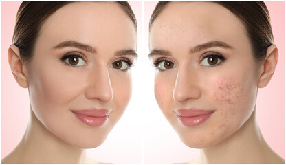 Young woman with acne problem before and after treatment on light background, collage. Banner design