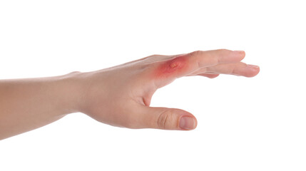 Woman with burn of her hand on white background, closeup