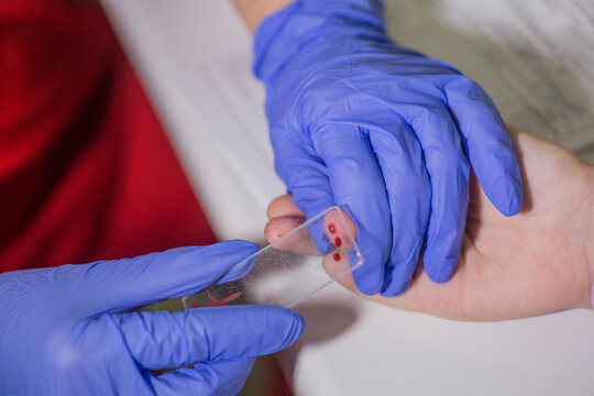 Doctor takes blood sample from a patient's finger.