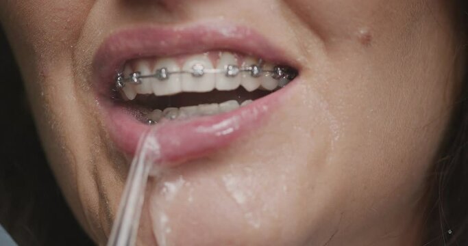 Water flosser, dental oral irrigator for braces care. Close-up female cleaning mouth from plaque. Dental hygiene routine