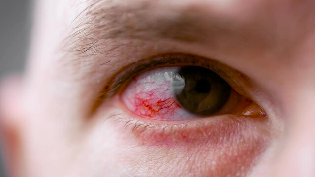 A man with a red, sore eye. An infection during illness struck the eyes.