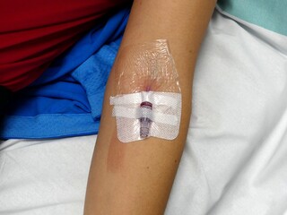 Modern peripheral venous catheter for intravenous infusion in the female arm in the hospital