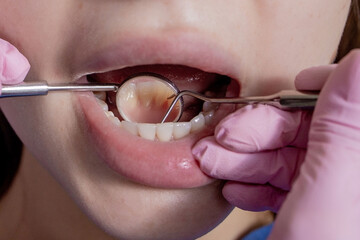 Dentist examining patient teeth with a mouth mirror and dental excavator. Close-up view on the woman