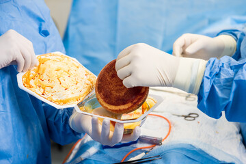 Breast augmentation under the guidance surgeons team in surgical operating room.