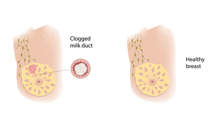 Woman healthy breast and Clogged milk duct. Comparison. Medical vector illustration.