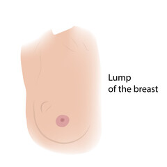 Woman breast. Lump. Cancer symptoms view with description. Medical vector illustration.