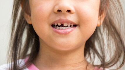 Smilling girl with broken milk tooth by accident