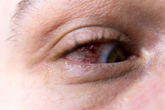 sore eye close-up. Burst blood vessels in the eyeball. Allergic reaction of the eye. Tired eyes. Computer fatigue. Viral eye disease. conjunctivitis close-up
