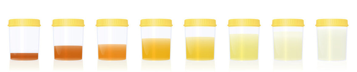 Urine colors, gradations from clear to yellow and orange and even darker, samples in specimen cups with different colored urine -. Indicator of the level of dehydration. Vector on white.
