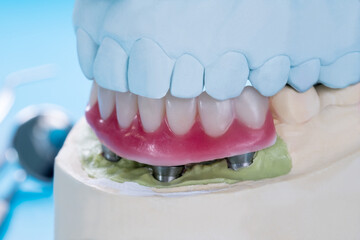 Closeup/ Dental implants supported overdenture on blue background/ Screw retained/ implant restorations.