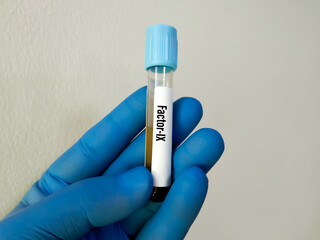 Biochemist or Lab Technologist holds Blood samples for factor XI or plasma thromboplastin...