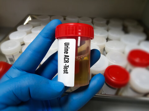 Urine Sample for Urine ACR (Albumin creatinine Ratio). Diagnosis of renalKidney disease. CCR (creatinine creatinine Ratio)