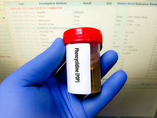 Urine drugs test sample for determine presence of illegal drugs in urine for judicial or medical...
