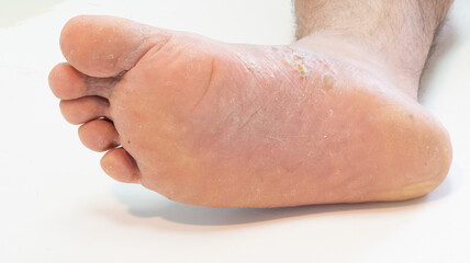 a man's foot with fungus skin disease