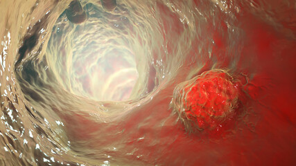 Intestinal carcinoma, colorectal cancer, bowel neoplasia, 3D illustration